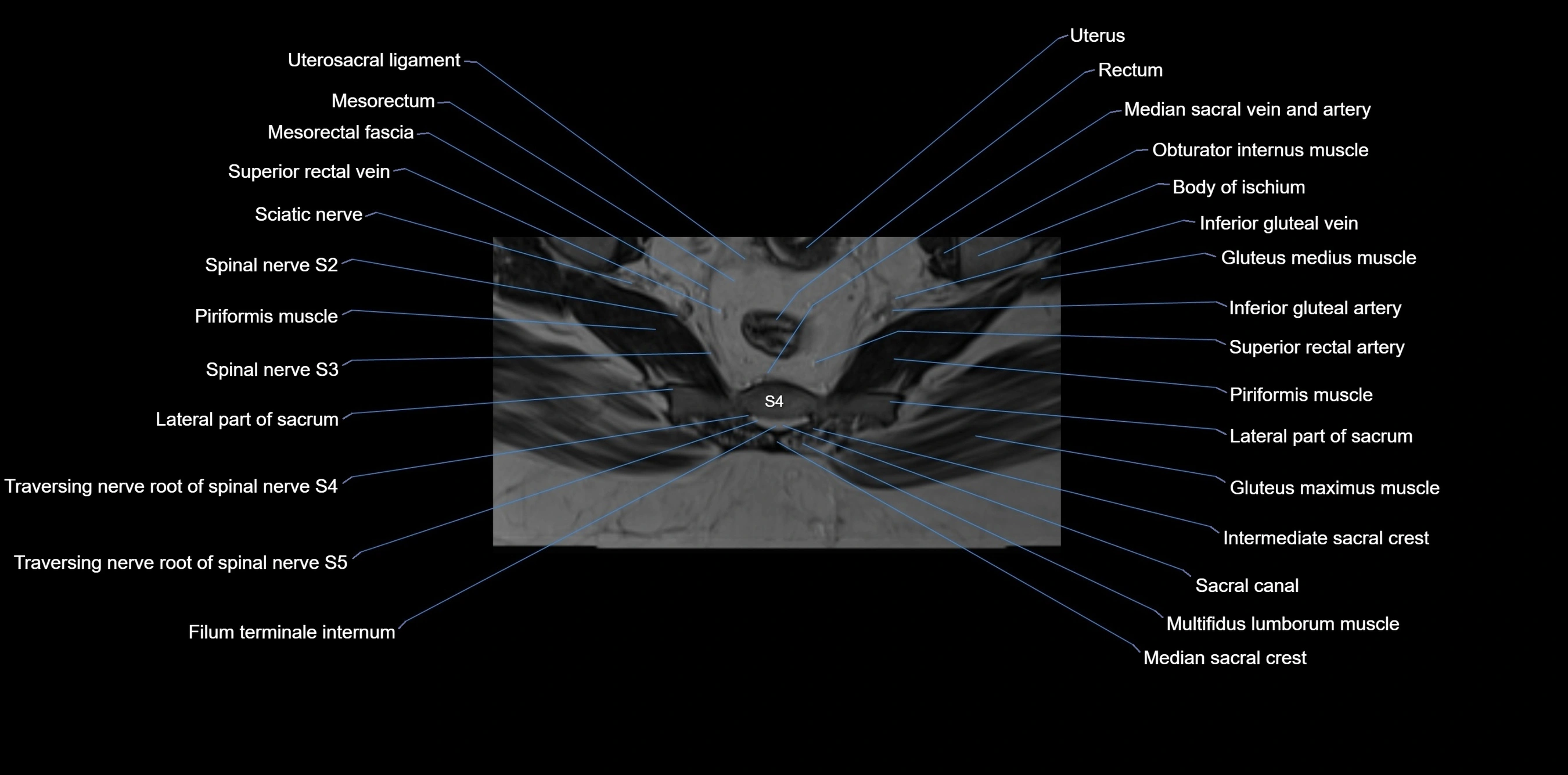 MRI sacrum, coccyx and sacroiliac joint axial cross sectional anatomy 3T  radiology  image-img-00001-00046.webp
